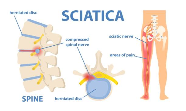 Understanding Sciatica Types of Migraine We Treat at Swarayu Clinic